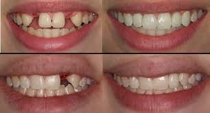 Dental Implants Fairfax VA