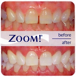 Teeth Whitening Fairfax VA